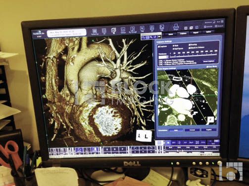 Siemens Definition AS 64 Slice CT